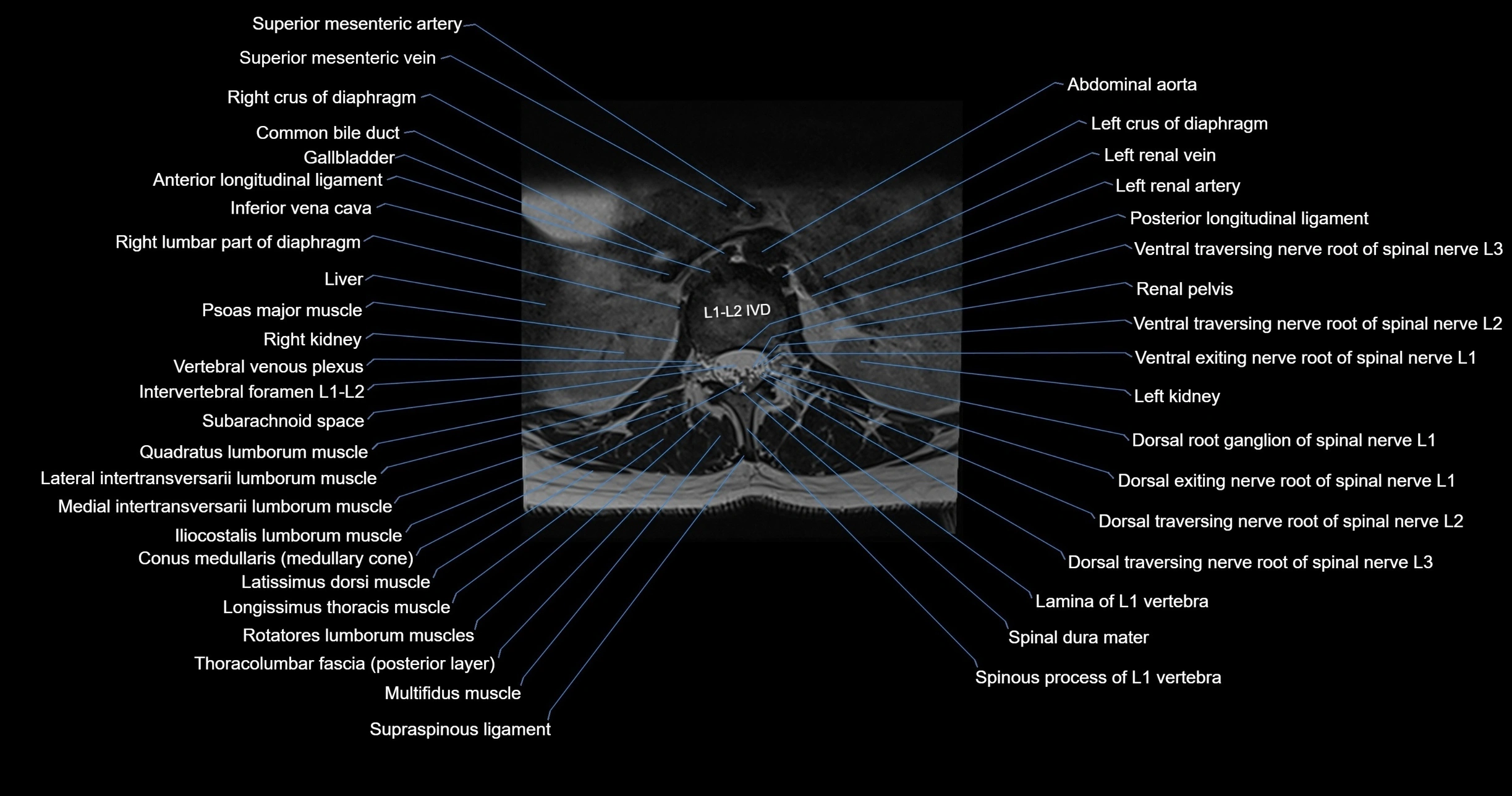 MRI lumbar spine axial cross sectional anatomy 3T radiology  image-img-00001-00010.webp